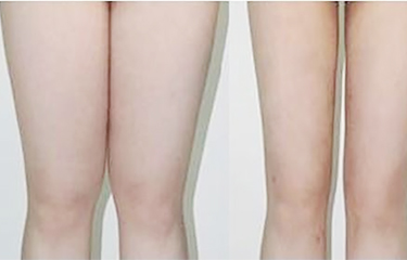 美容院減贅肉儀器真的能瘦嗎？會不會對身體有影響？